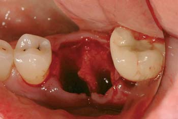 graft containment 1 with AlloDerm SELECT GBR