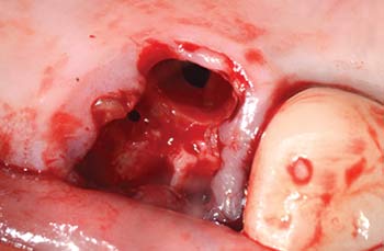 Mem-Lok Pericardium case image 1