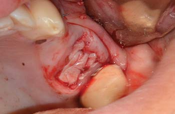 Mem-Lok Pericardium case image 3